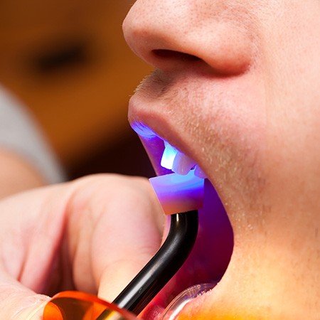 UV light shining on a tooth