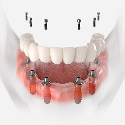 Dental implant next to model of natural tooth